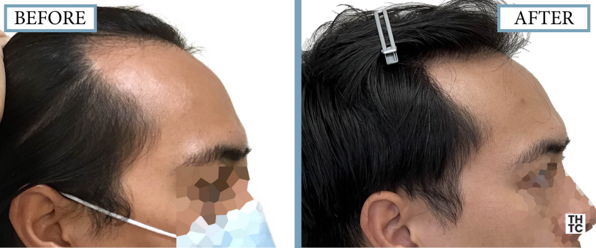 Hair Transplant Toronto